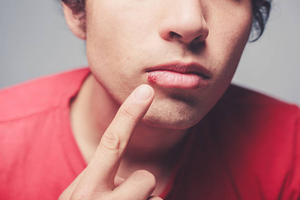 Cara Menyembuhkan Herpes Panduan untuk Pengobatan dan Pencegahan